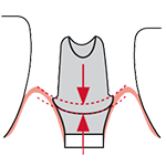 Abutment Margin Depth