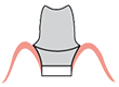 Tissue Displacement