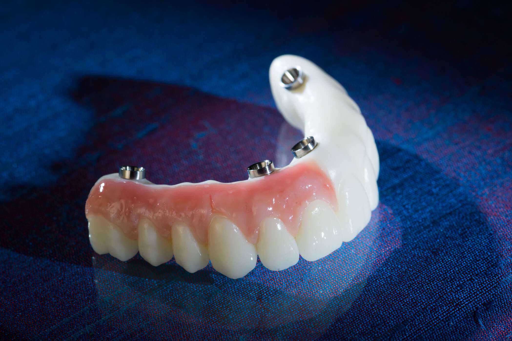 DuraTemps PMMA provisionals produced by Burbank Dental Lab