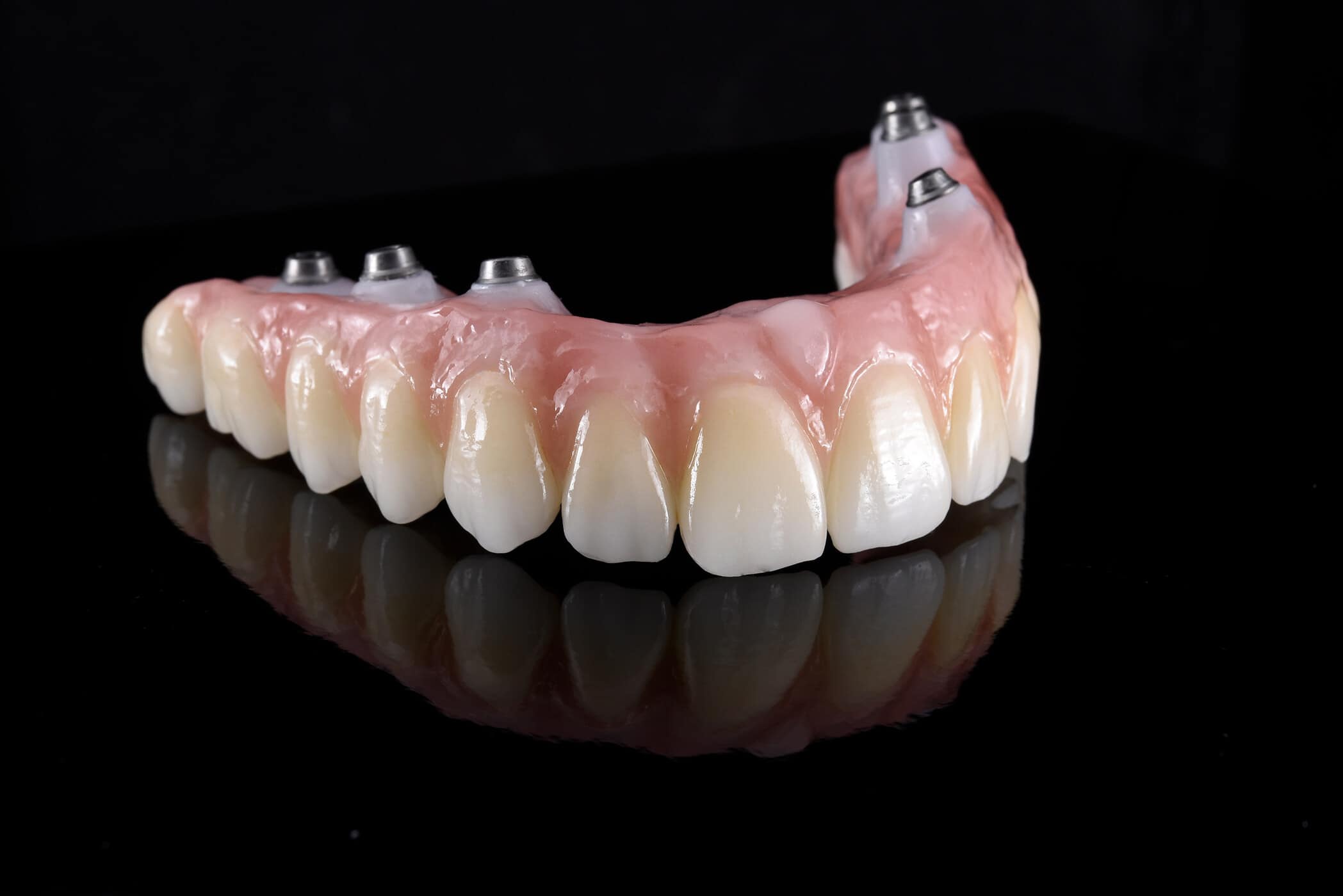 Имплантация зубов all on 6. Циркониевый протез на 6 имплантах. Циркониевая балка на 6 имплантах. Несъемные иммедиат-протезы. Протез металлокерамика на 4 имплантах.