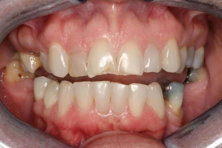 Burbank Dental Lab patient before full mouth rehabilitation