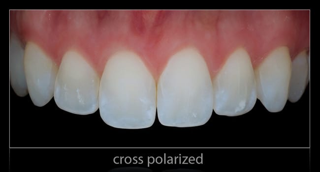 Denture Teeth Color Chart