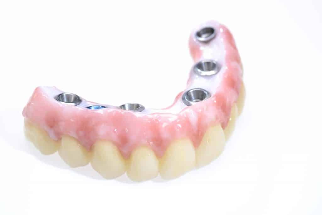 Full zirconia restoration fabricated by Burbank Dental Lab