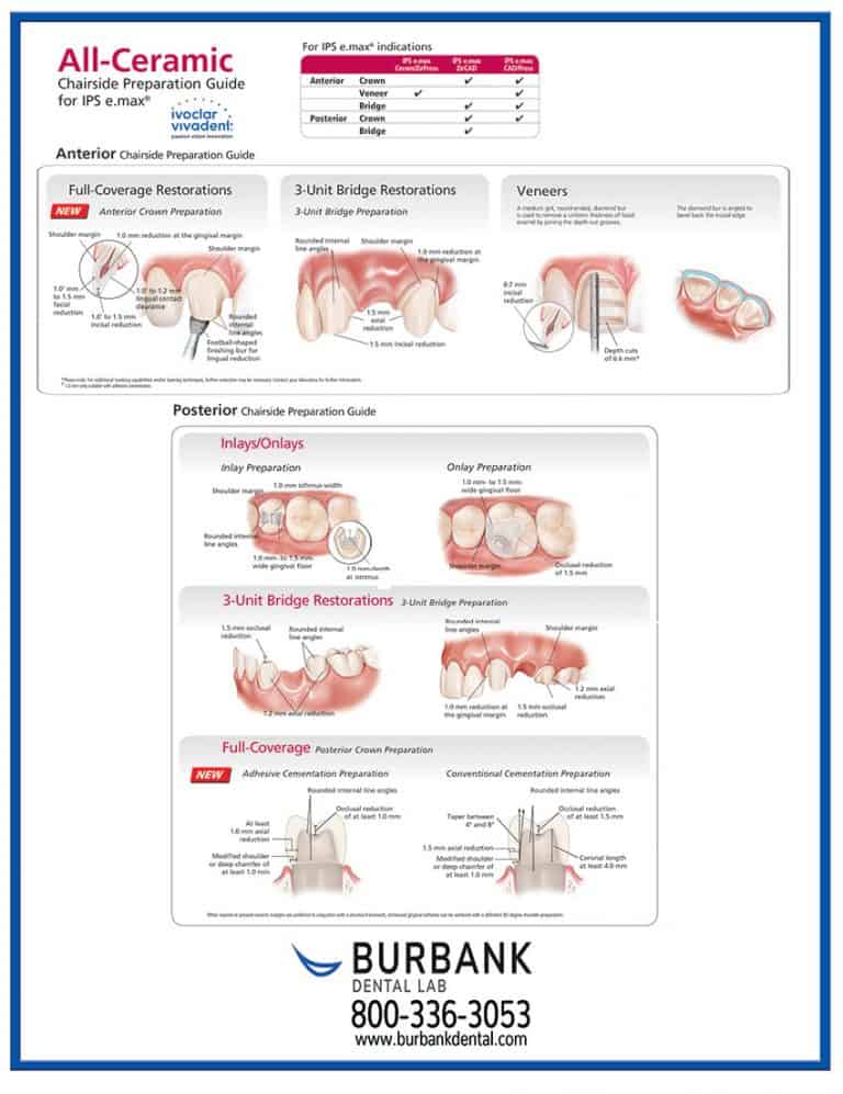 IPS e.max all-ceramic chairside prep guide Burbank Dental Lab