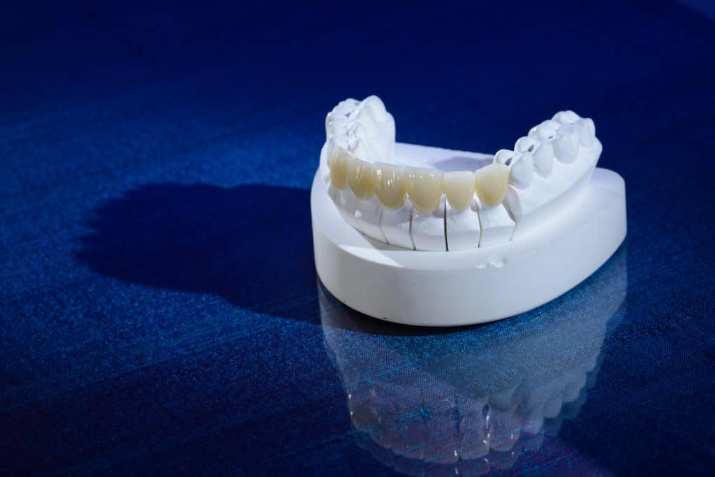 IPS e.max restoration fabricated by Burbank Dental Lab