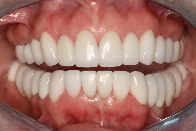 Burbank Dental Lab patient after full mouth rehabilitation with Zir-MAX