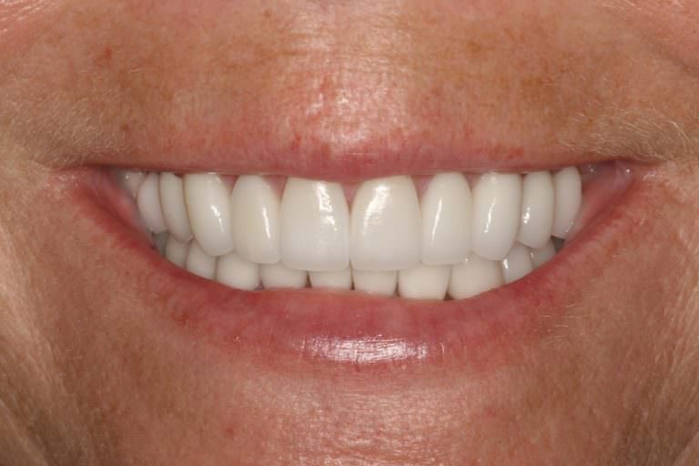 Burbank Dental Lab patient after full mouth Zir-MAX rehabilitation