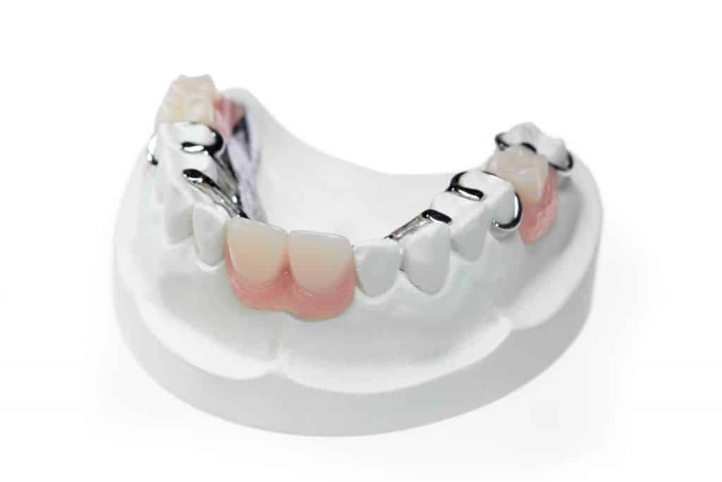 Vitallium partial denture created by Burbank Dental Laboratory