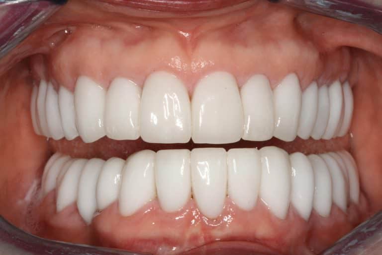 Burbank Dental Lab patient after Zir-Max Layered and Monolithic