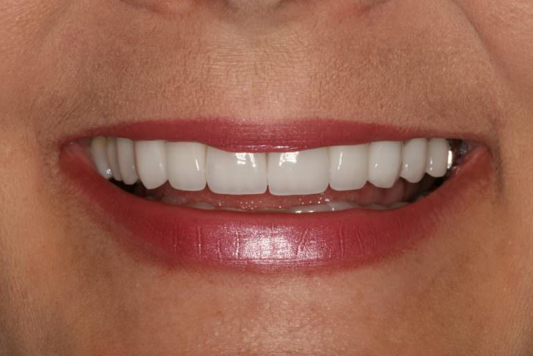 Burbank Dental Lab patient after e.max restorations