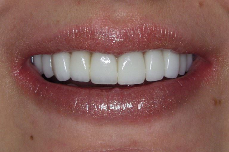 Burbank Dental Lab patient after e.max layered restorations were placed.