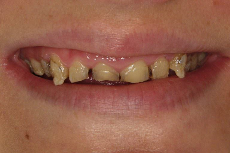 Burbank Dental Lab patient before e.max restorations