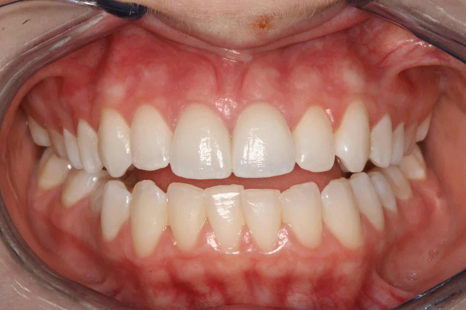 Burbank Dental Lab after e.max veneers on front teeth