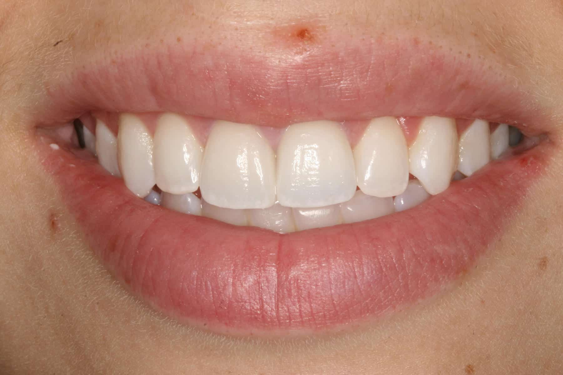 Burbank Dental Lab patient after veneers on two front teeth