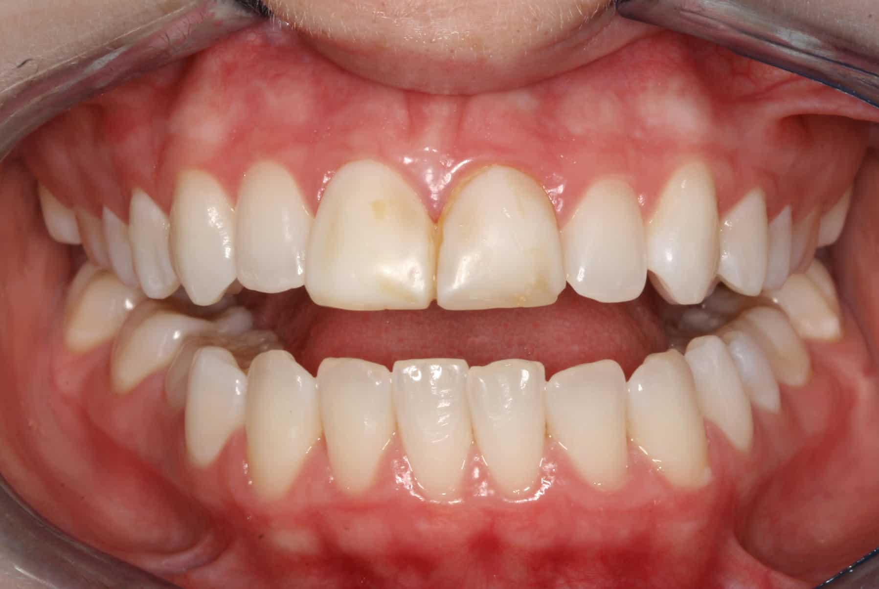 Burbank Dental Lab patient before veneers