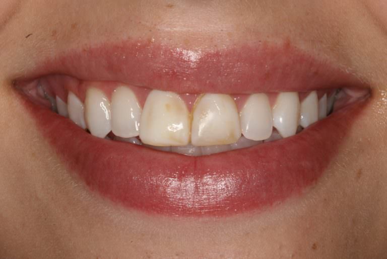 Burbank Dental Lab patient needing veneers on front teeth