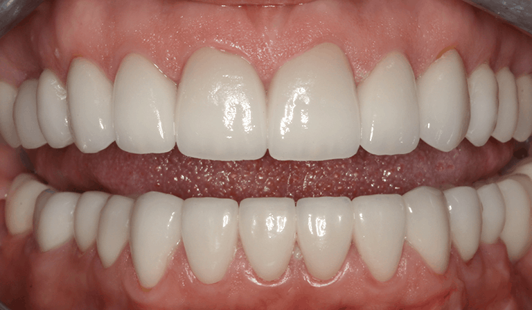 Burbank Dental Lab patient after receiving Zir-MAX layered restorations