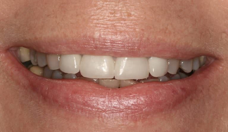 Burbank Dental Lab patient before Zir-MAX layered crowns