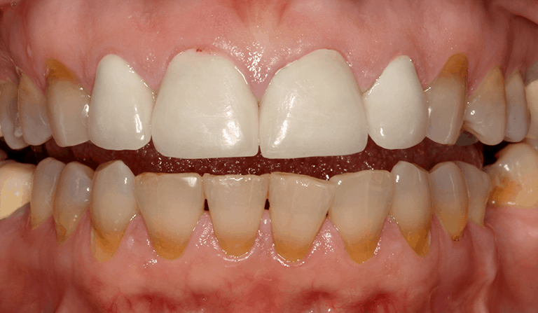 Burbank Dental Lab before Zir-MAX crowns