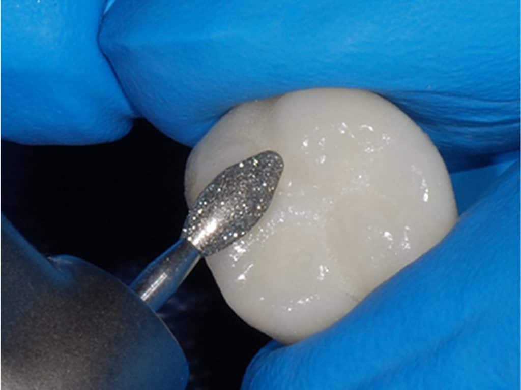 zirconia how crowns to polish Dental Zirconia Polishing  Lab Burbank