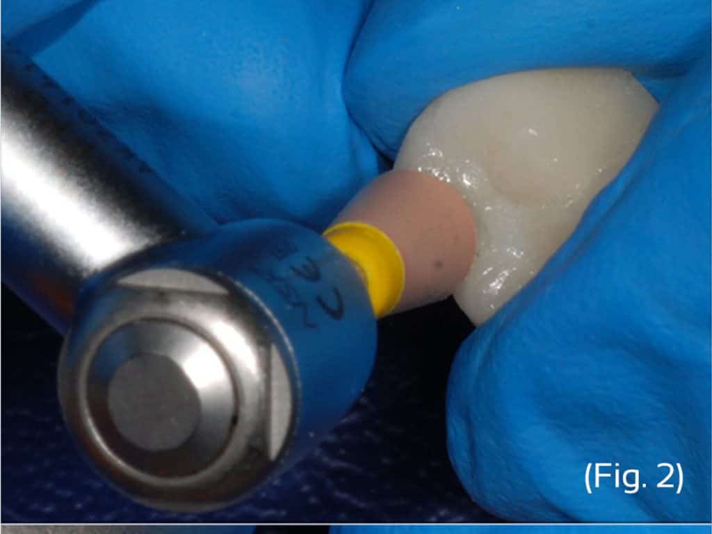 How to polish zirconia by Burbank Dental Lab