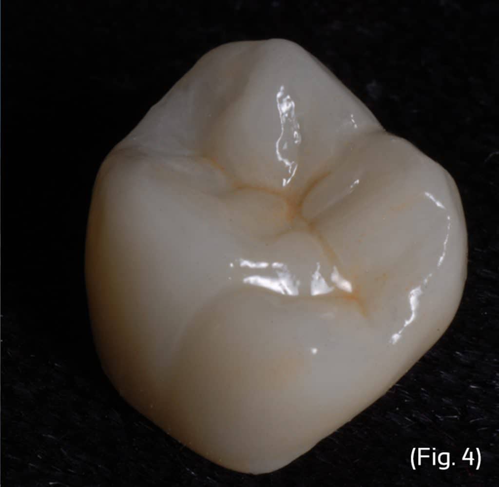 polishing-zirconia-burbank-dental-lab