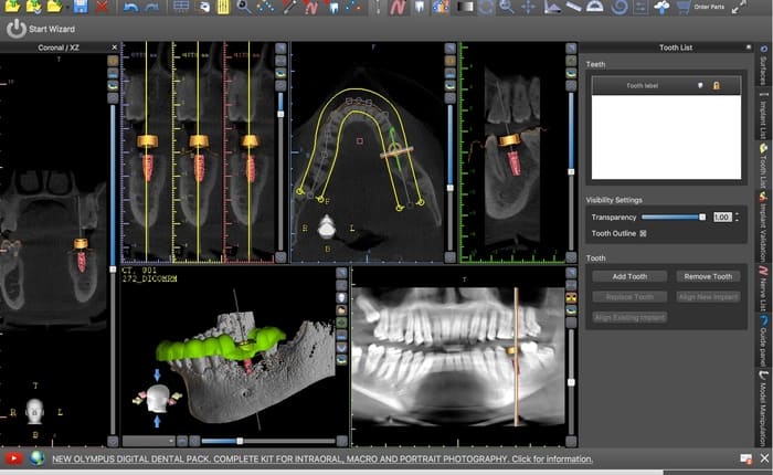 Blue Sky Bio screen for guided surgery appliance