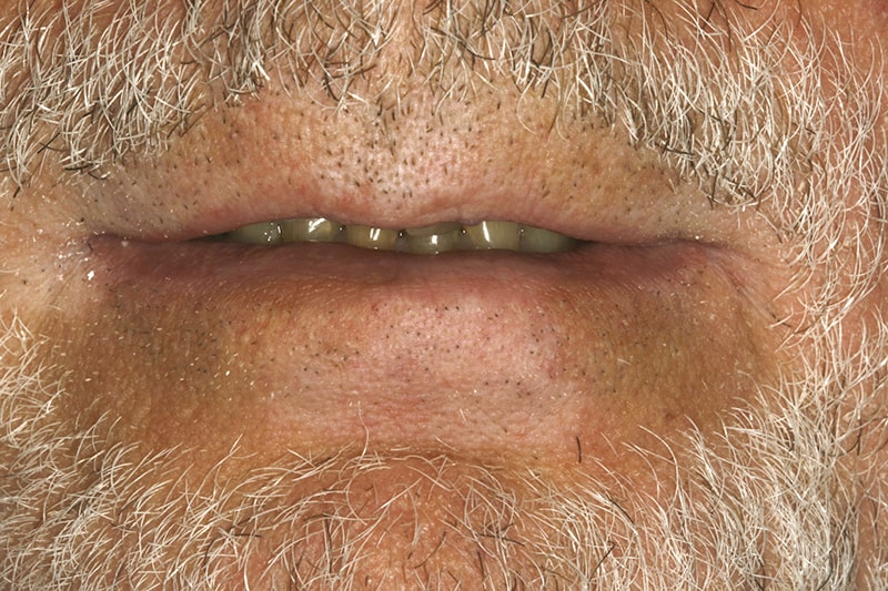 Figure 1: Full Mouth Dental Restorative Case