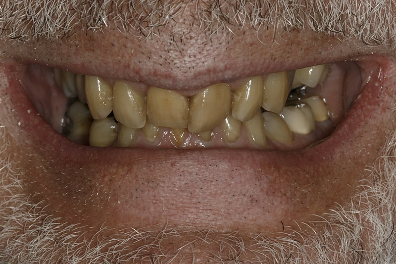 Figure 2: Full Mouth Dental Restorative Case