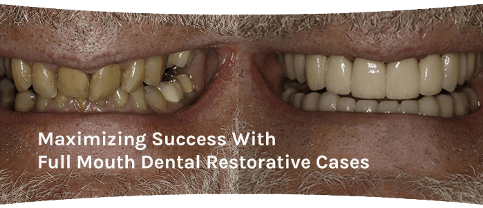 Maximizing Success with Full Mouth Dental Restorative Cases