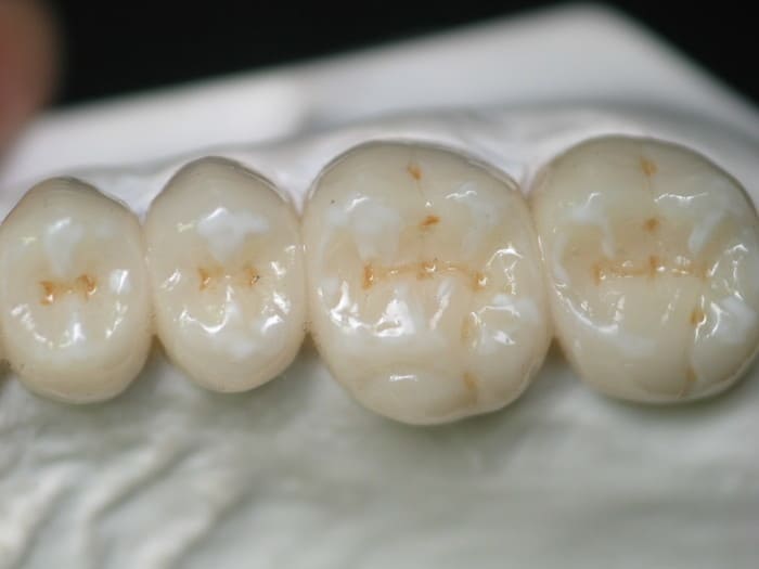 Burbank Dental Lab DuraTemps® provisionals