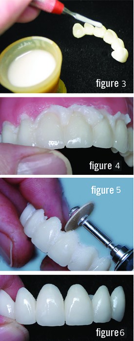 Burbank Dental Lab DuraTemps Provisionals directions