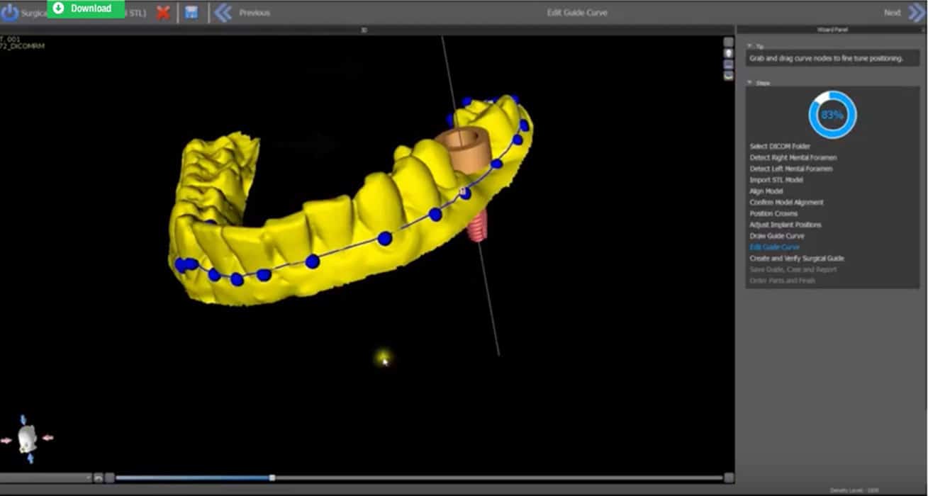 Burbank Dental Lab design guide - guided surgery appliance