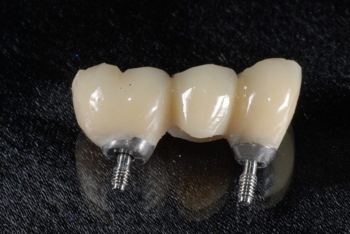 Immediate load provisional Figure 4 Burbank Dental Lab provisional