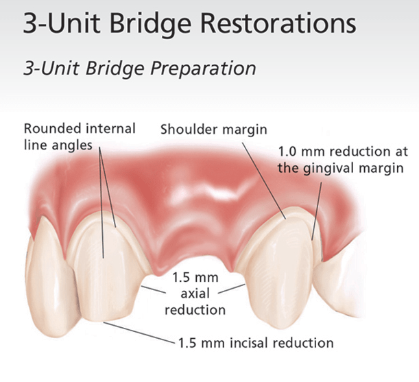 Burbank Dental Lab clinical guide for e.max restorations