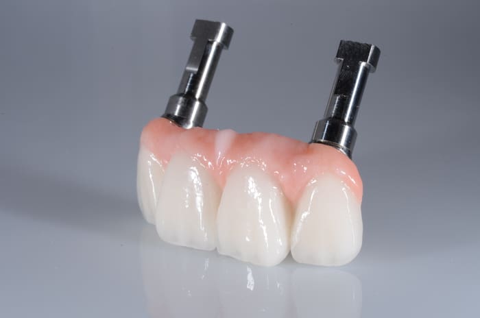 Burbank Dental Lab Smart1® dental restoration