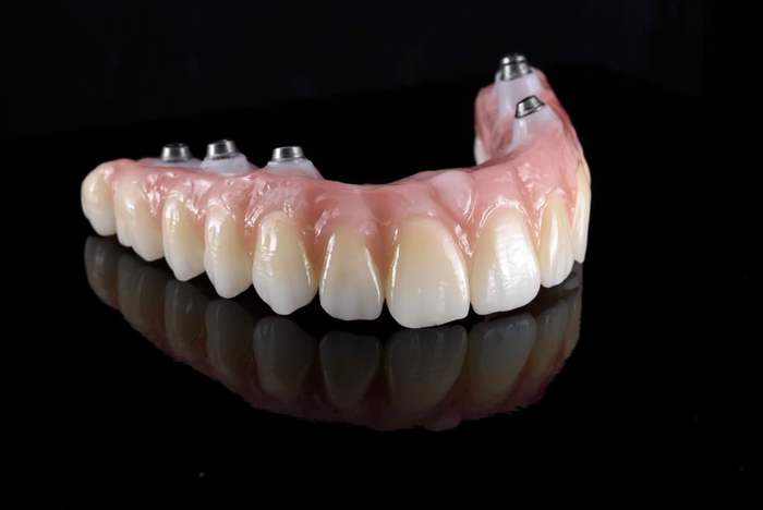 Hybrid prosthesis Figure 7 Burbank Dental Lab prosthesis