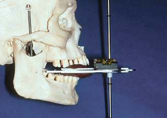 Burbank Dental Lab, Kois Bow instructions