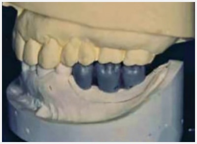 Wax-Up for Scanning Guide - Burbank Dental Lab