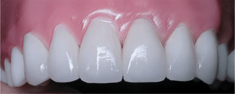 Burbank Dental Lab DuraTemps provisionals teeth