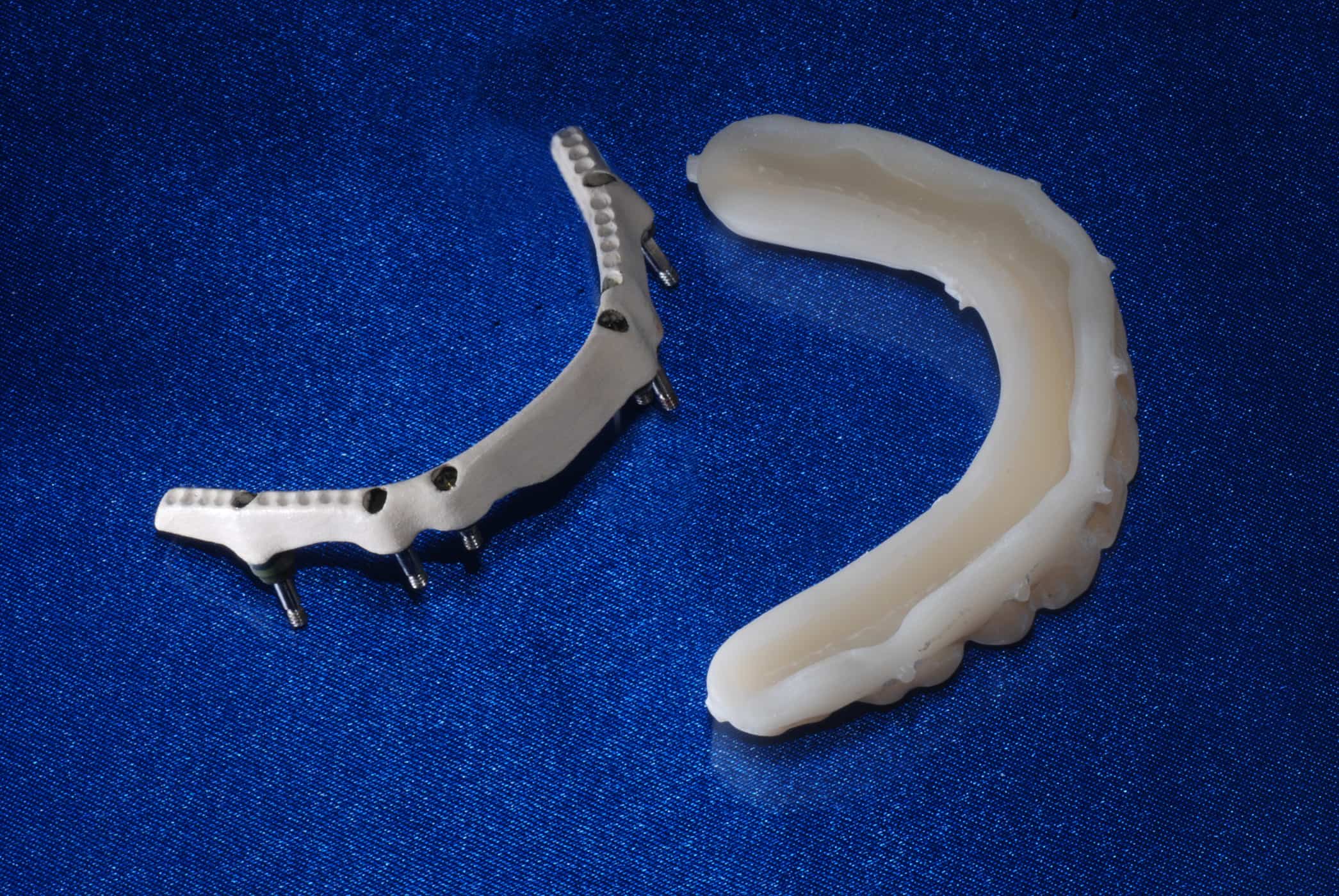 Hybrid denture prosthesis SmartComposite Hybrid denture prosthesis SmartComposite