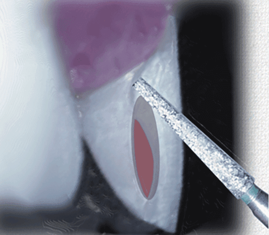 nano-prep-guide-dog-leg Burbank Dental Lab nano prep guide for porcelain veneers