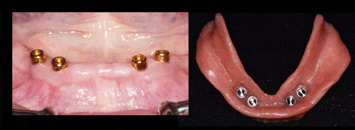 over-denture-figure-1 Implant-retained overdenture from Burbank Dental Lab
