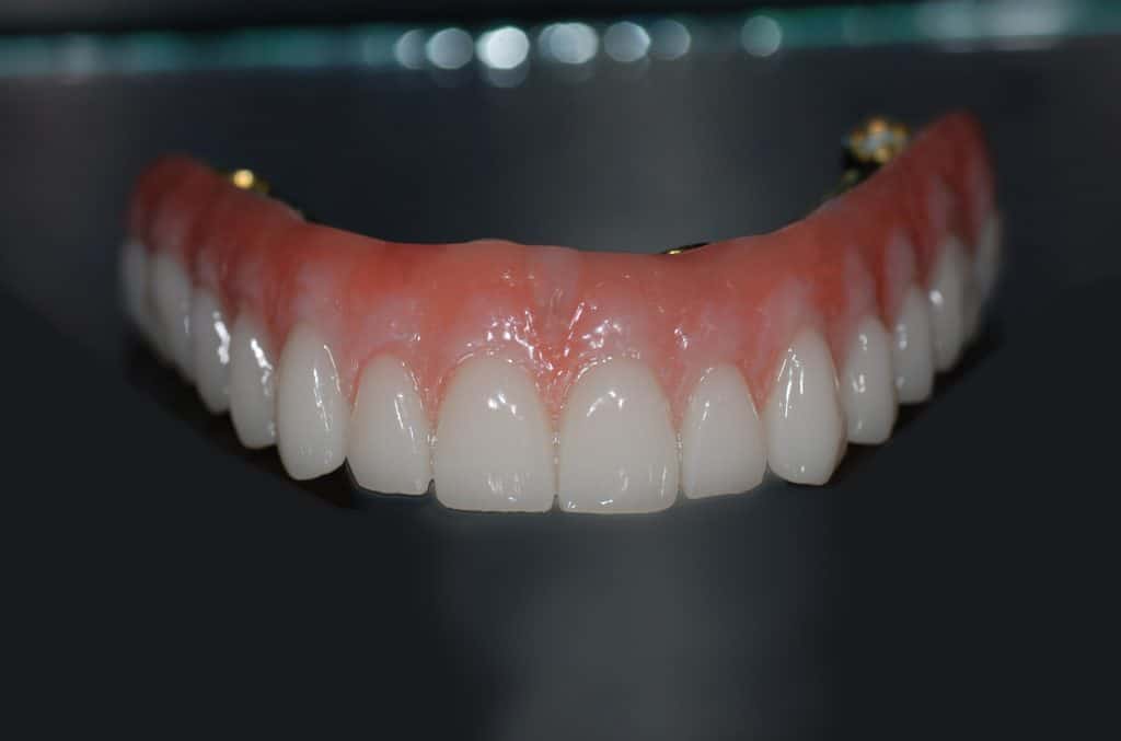 The Hybrid Denture in a Class of its Own Burbank Dental Lab