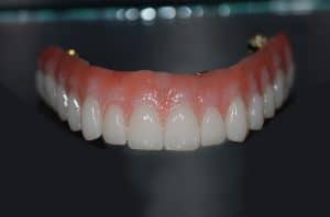 Hybrid denture SmartComposite