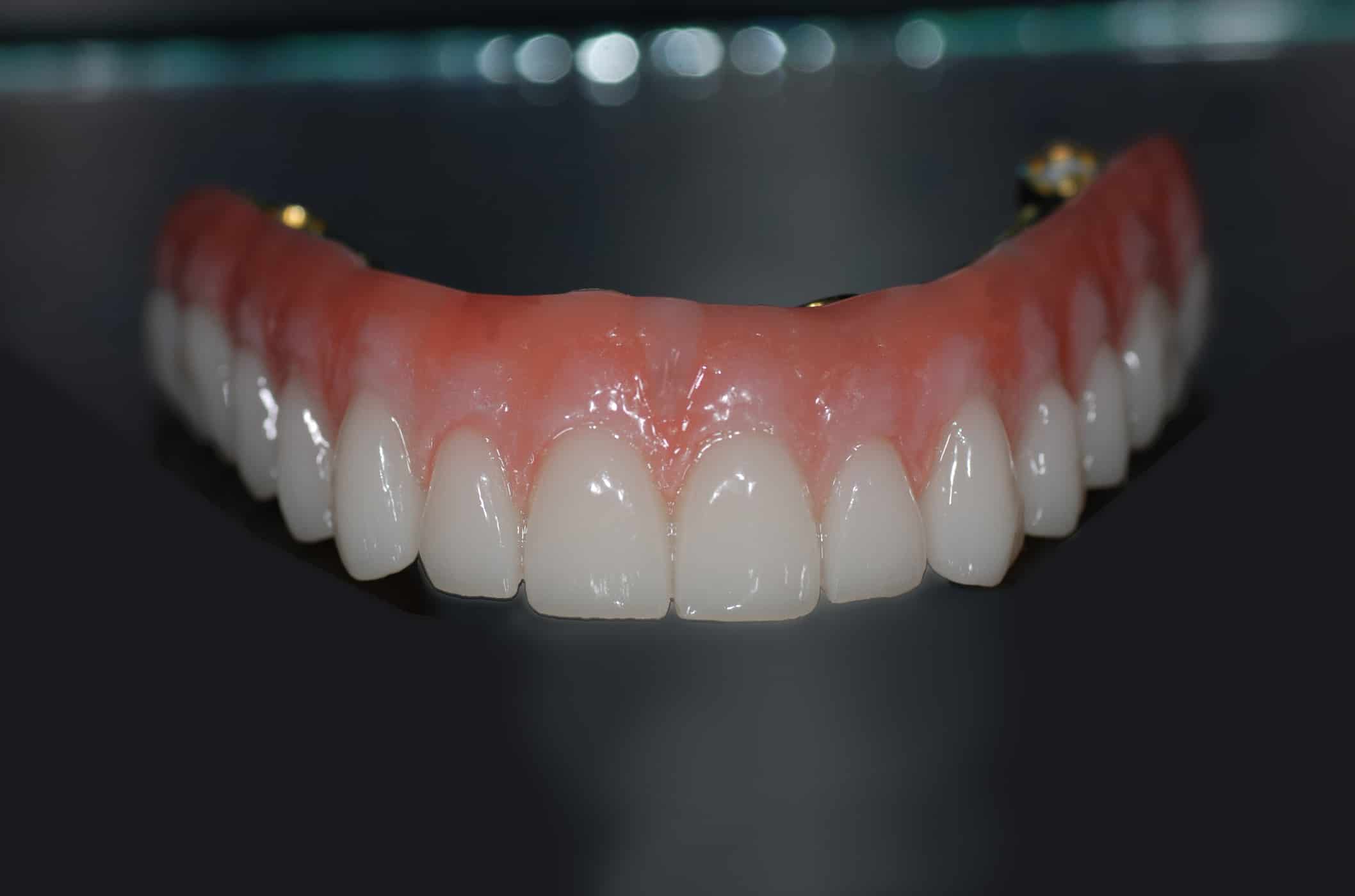 The Hybrid Denture in a Class of its Own - Burbank Dental Lab