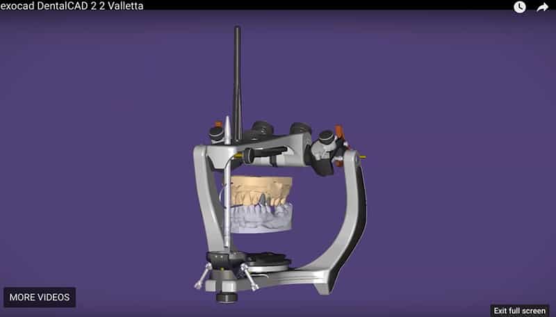 Exocad articulator used for digital wax-up