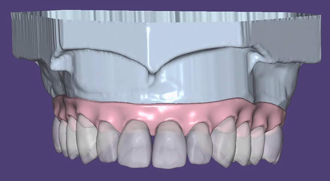 Burbank Dental Lab - Exocad Virtual Wax-Up Crop