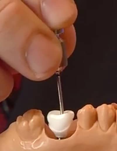 Straight access to screw-retained restoration