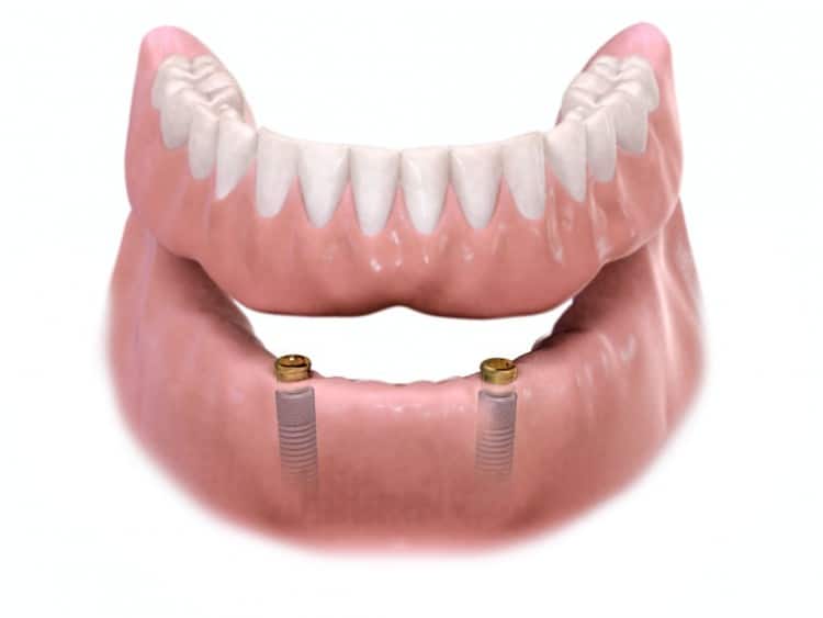 Implant-retained denture